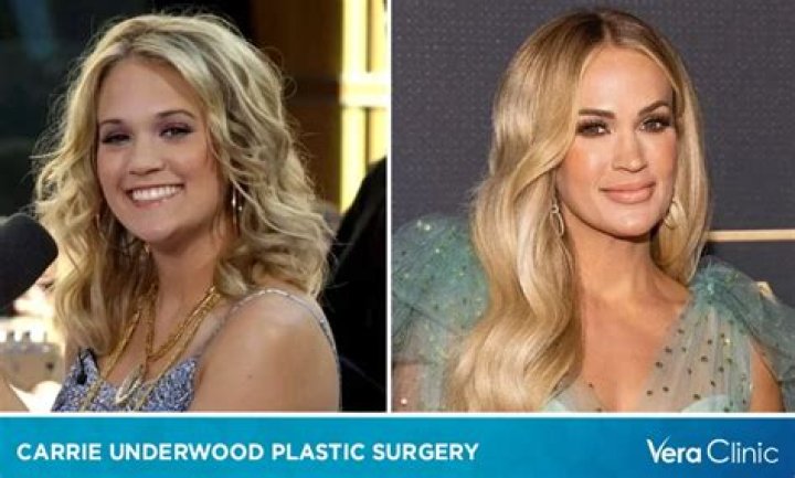 
Carrie Underwood Face Accident -Has Carrie Had Plastic Surgery? Before And After Photos 
