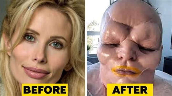 Clarissa Ward Surgery History, Did She Undergo Face Lift?