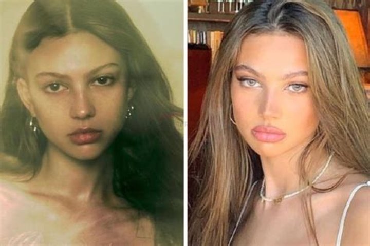 
Did Katarina Deme Get Plastic Surgery Such As Botox? 
