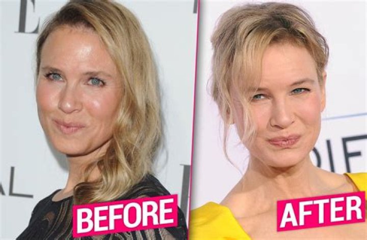 
Did Renee Zellweger Get Her Lips And Nose Done? Plastic Surgery Before And After Photos 