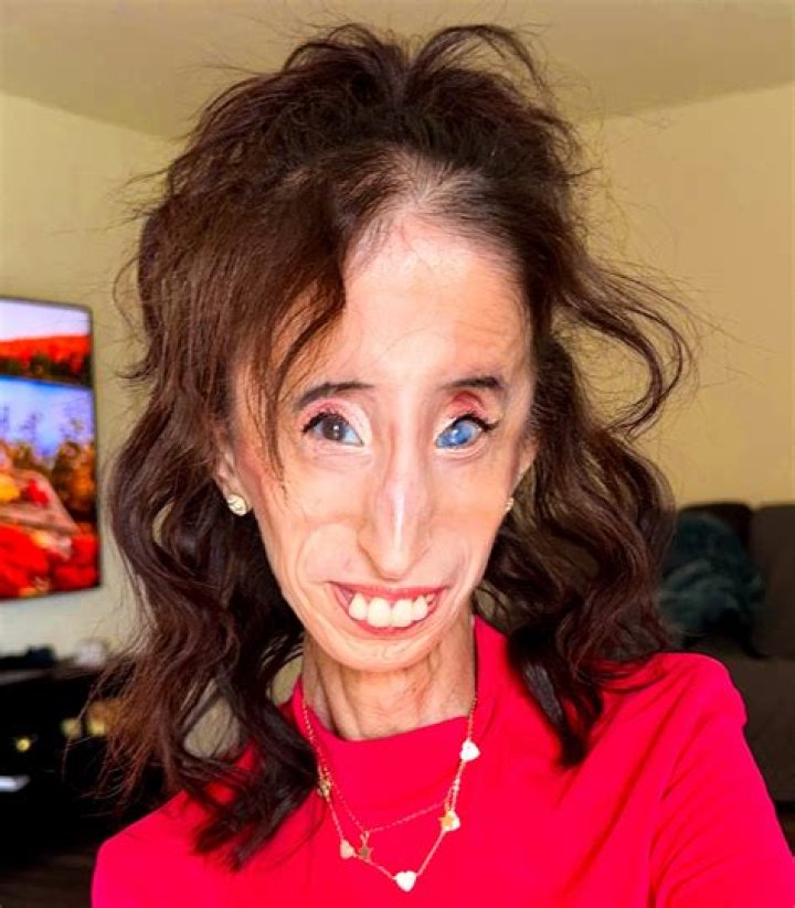 
Lizzie Velasquez Illness: What Disease Does Lizzie Velasquez Have? 