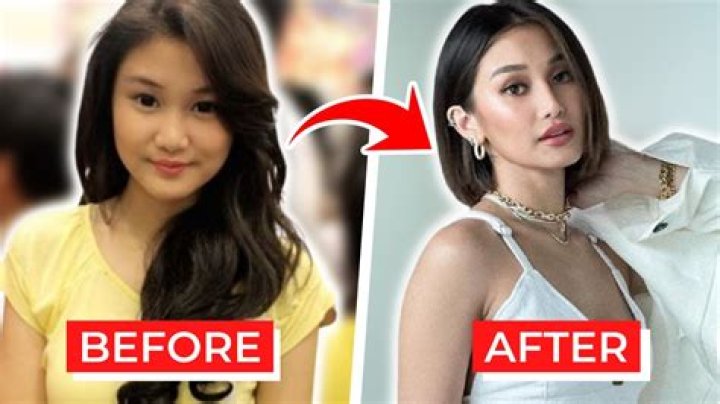 Lovi Poe Before Surgery | Filipino Actress Plastic Transformation