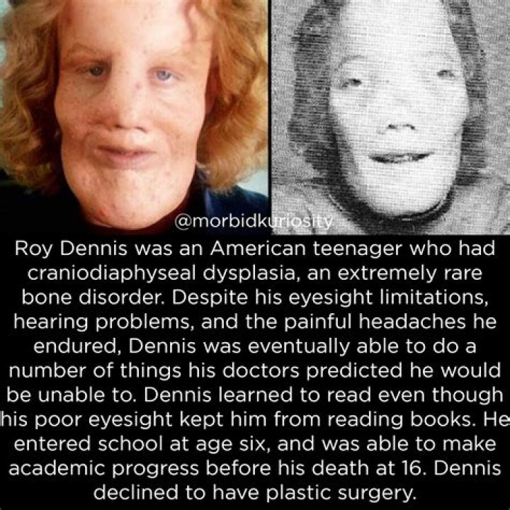 Rocky Dennis Cause of Death, How did Rocky Dennis Die?