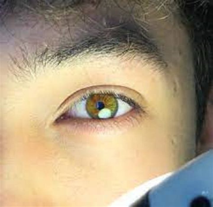 What Happened To Seth Fedelin Eyes: Is He Suffering From Disease?