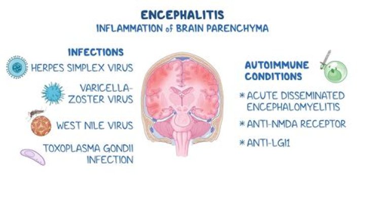 What Is Viral Encephalitis? Liza Minnelli Illness & Life in Wheelchair