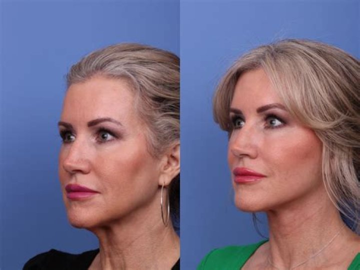 
Where Has Gloria Borger Been? Did She Vanish To Have Facelift & Plastic Surgery? 